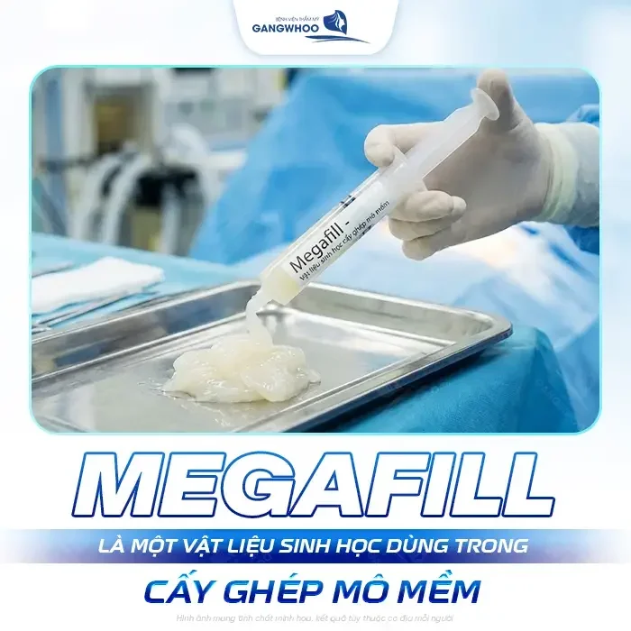 Tăng Kích Thước Dương Vật Bằng Tiêm Chất Làm Đầy Độn Mô Megafill